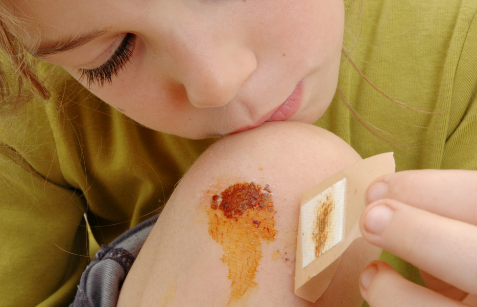 Mercuchrom®-Jod Lösung in Anwendung